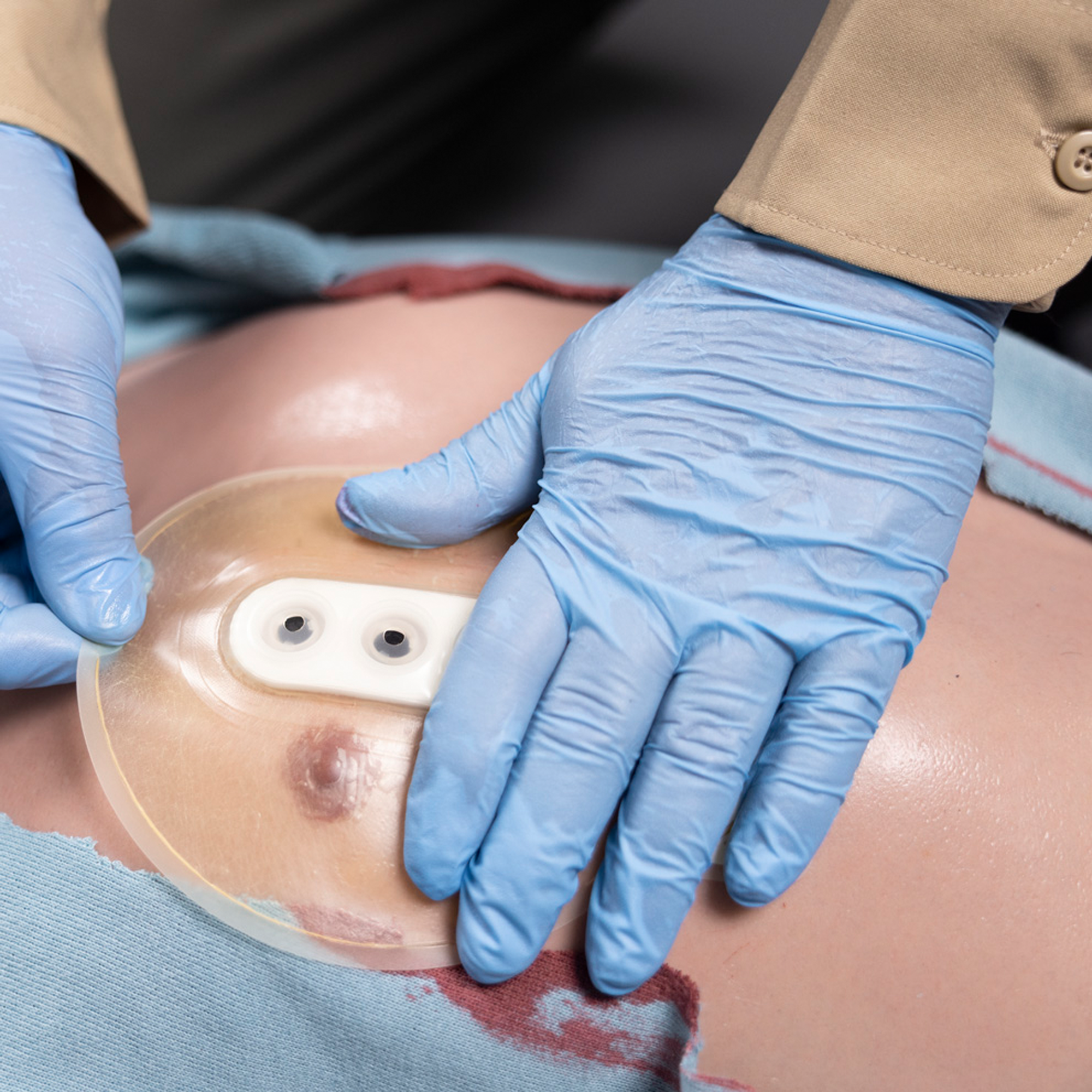 Bolin Chest Seal (BCS)